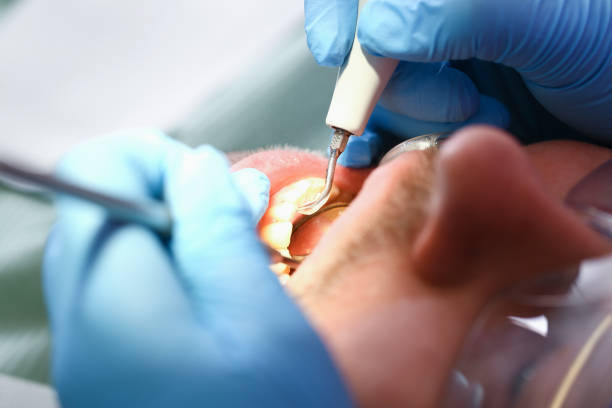 Best Emergency Tooth Extraction in Coudersport, PA